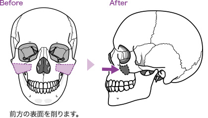 頬骨体部削骨術イメージ