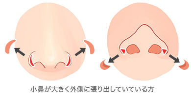 鼻翼基部外側切除術