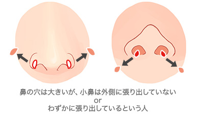 鼻翼基部内側切除術