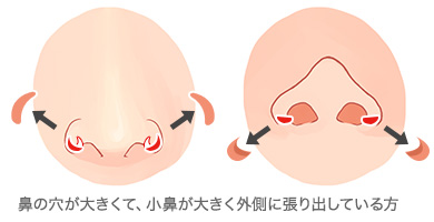 鼻翼基部外側内側切除(全層切除)