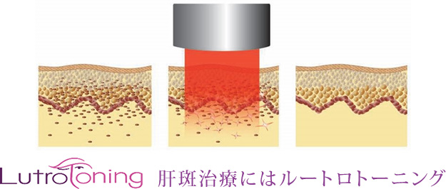 肝斑治療にはルートロトーニング